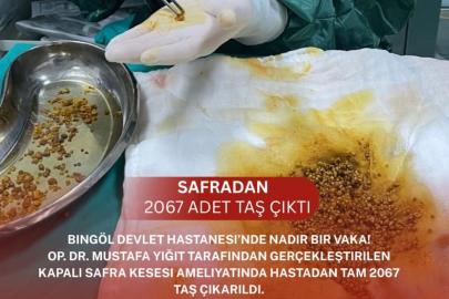 Safra kesesinden 2 bin 67 taş çıktı