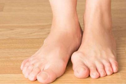 Halluks valgus yaşam kalitesini önemli ölçüde etkileyebilir